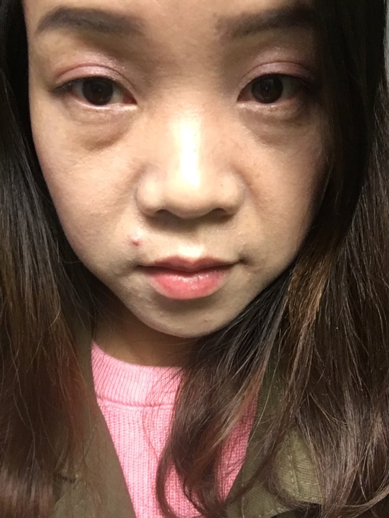 可以帮我看看我的眼睛是属于有眼袋还是泪沟啊,我发张照片帮我看看