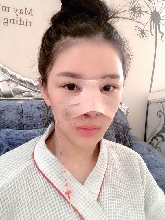 梦幻小人肋软骨隆鼻第1天美丽日记