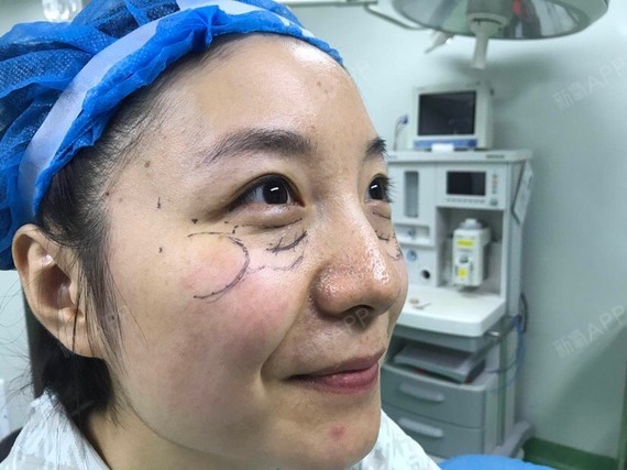 兰小鱼激光去黑眼圈第0天美丽日记-新氧美容整形