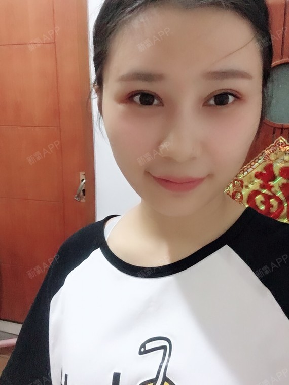 氧气7666791530197072玻尿酸垫下巴第53天