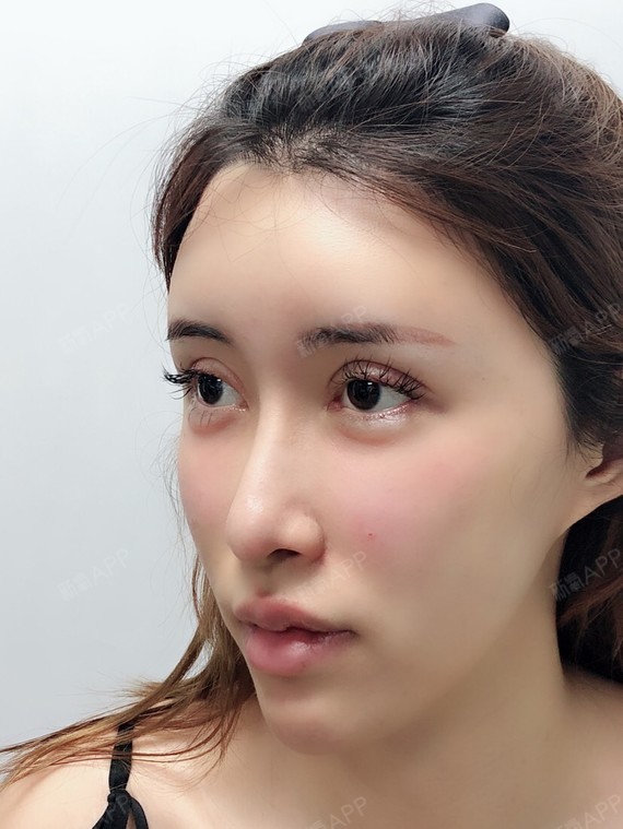 冷脸看泪眼玻尿酸丰唇第0天美丽日记-新氧美容整形