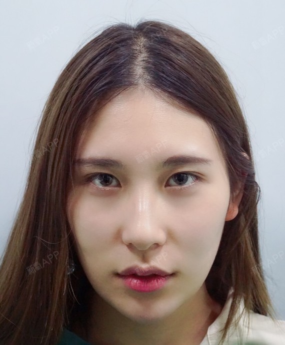 下眼下至术