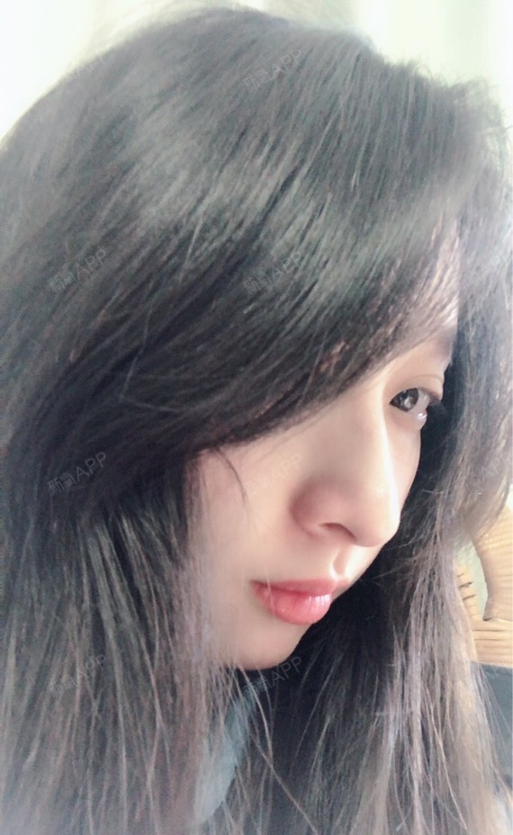 最最最最最最种植发际线第367天美丽日记-新氧