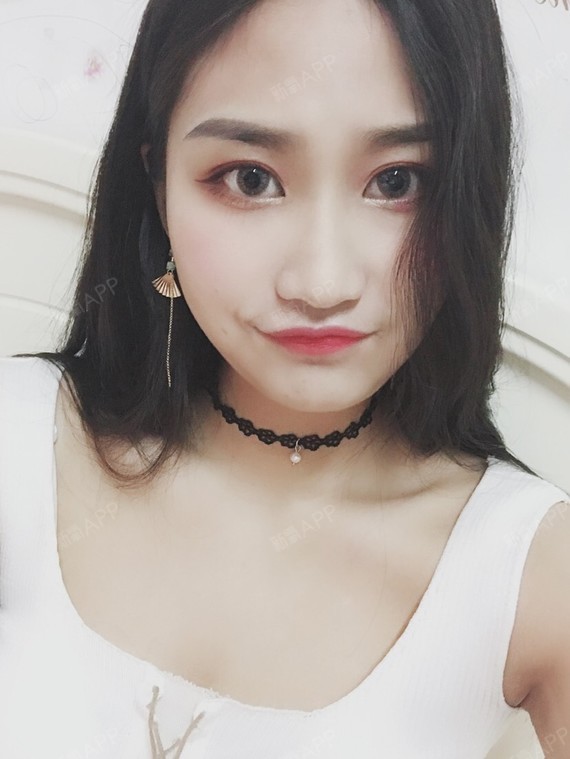 氧气3336361526299810 | 鼻部 | 术后当自强 | 鼻骨矫正 | 驼峰鼻矫正