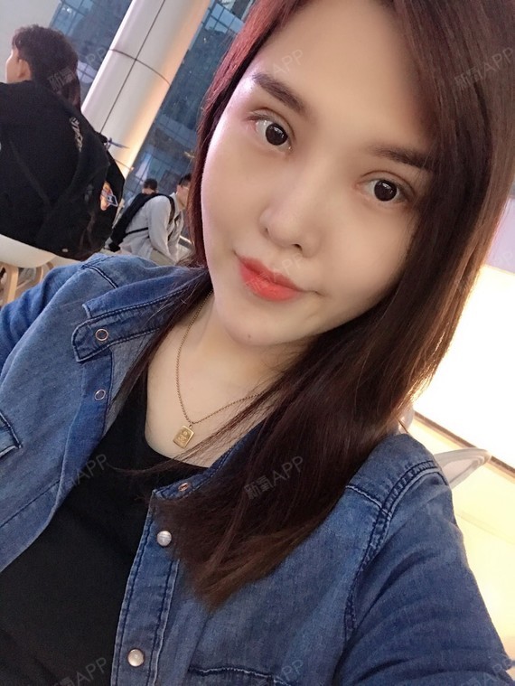 Memory21切开双眼皮第34天美丽日记-新氧美