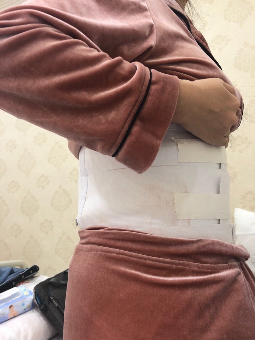 沈阳名流美容医院吸脂瘦腰腹怎么样_恢复过程_效果__9