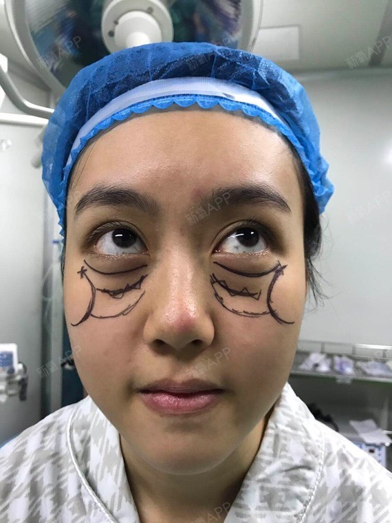 激光去黑眼圈