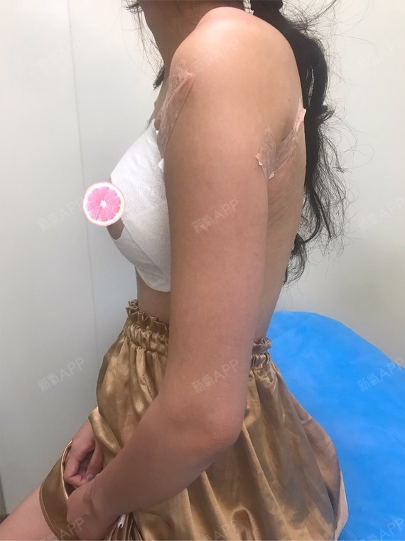 新氧 胖妞小甜甜 胸部 隆胸 假体隆胸 术后当自强 福州