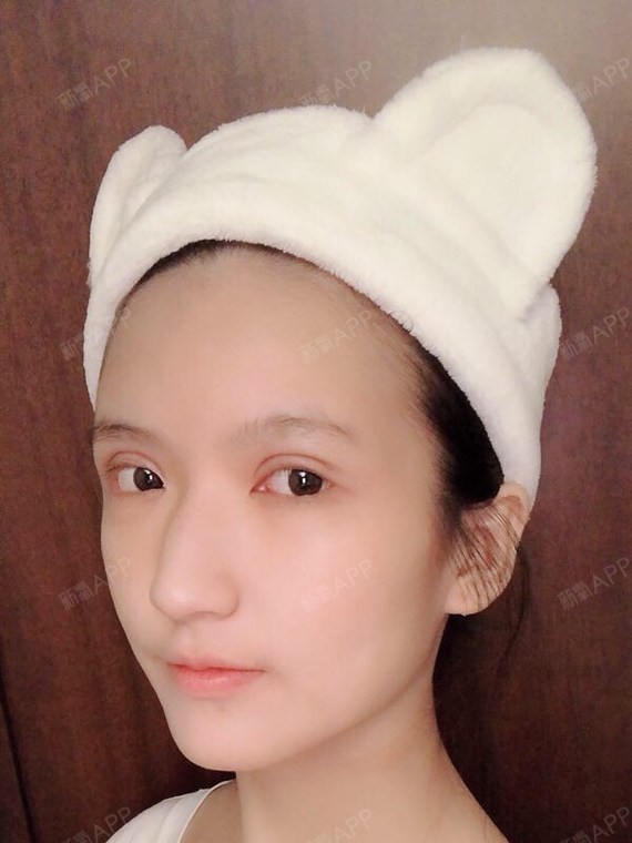 一给我哩giao切开双眼皮第8天美丽日记-新氧美