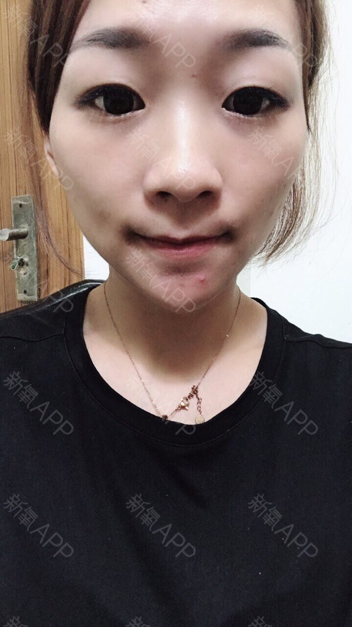不知不觉地,居然已经打了玻尿酸快半个月了,随手摸了摸下巴,好像已经