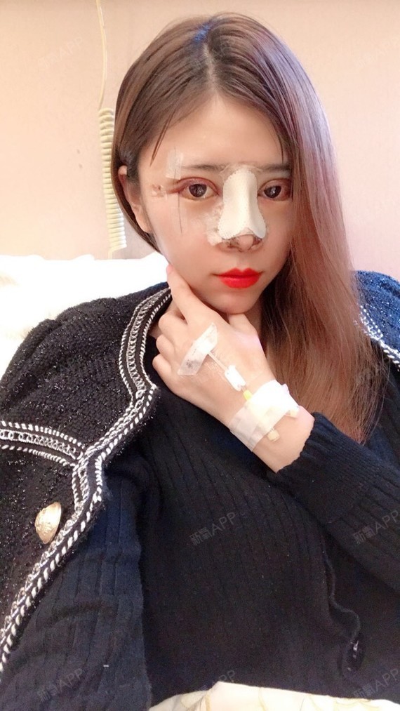 氧气xzsu2宽鼻矫正第1天美丽日记-新氧美容整