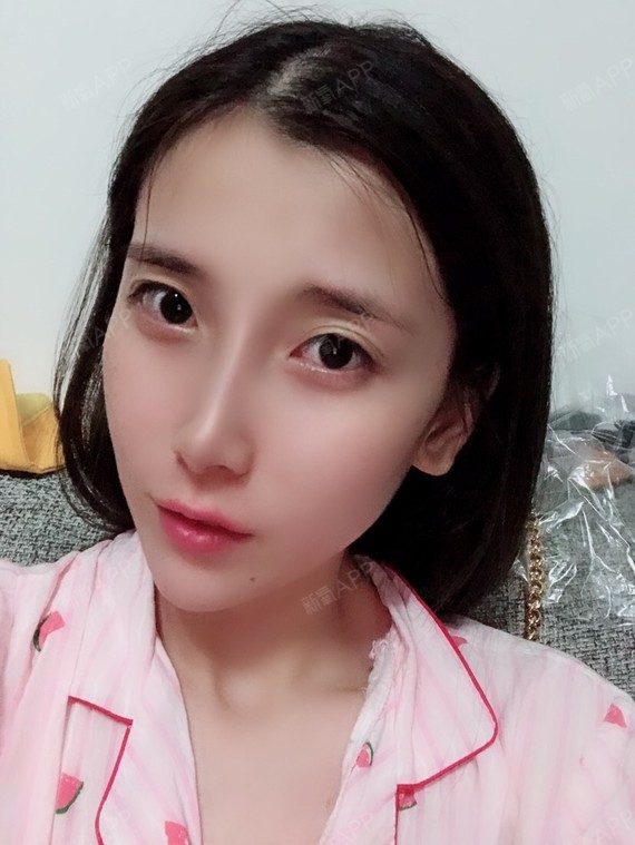 炜说故事肋软骨隆鼻第8天美丽日记