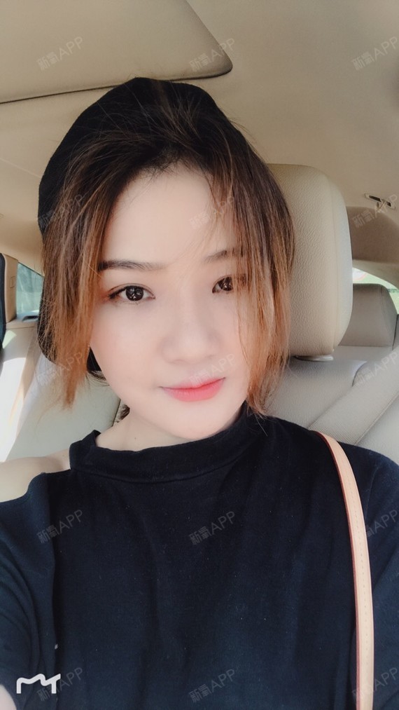 陌爱87埋线提升第90天美丽日记-新氧美容整形