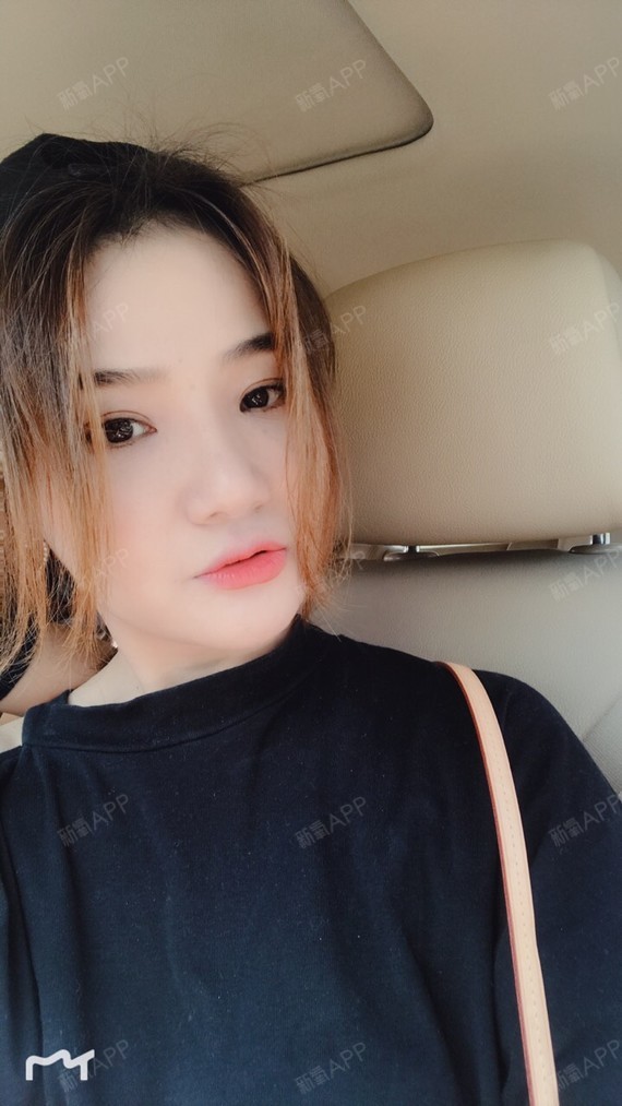 陌爱87埋线提升第90天美丽日记-新氧美容整形