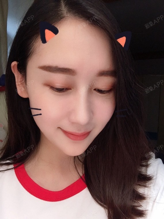 玻尿酸丰额头