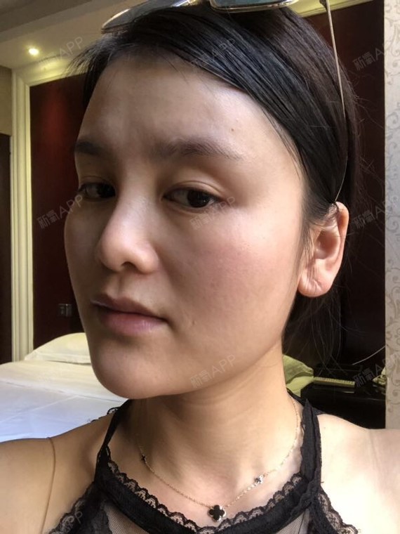 大不了唱首歌美白针第11天美丽日记-新氧美容