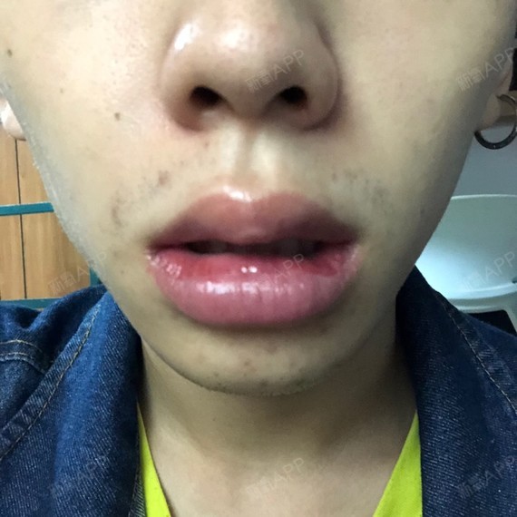 长沙m唇手术好不好_效果图_bobyleem唇手术术后第7天