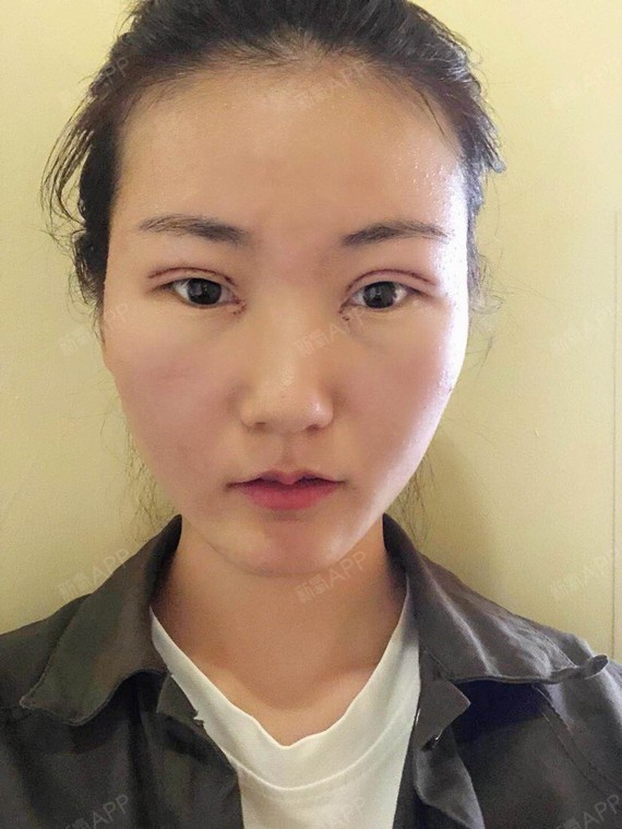 济南鹏爱美容整形医院切开双眼皮第6天美丽日