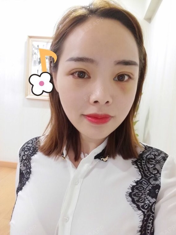 上眼睑 | 上眼睑去脂 | 眼部修复 | 天津同城 | 定点双眼皮 | 570