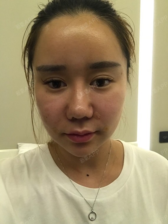 溶脂瘦脸好不好_效果图_小番茄i溶脂瘦脸术后第5天