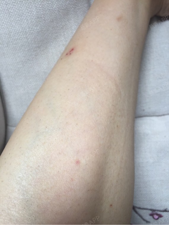 脱完小腿毛以后起了红疹,好痒,现在好点了.