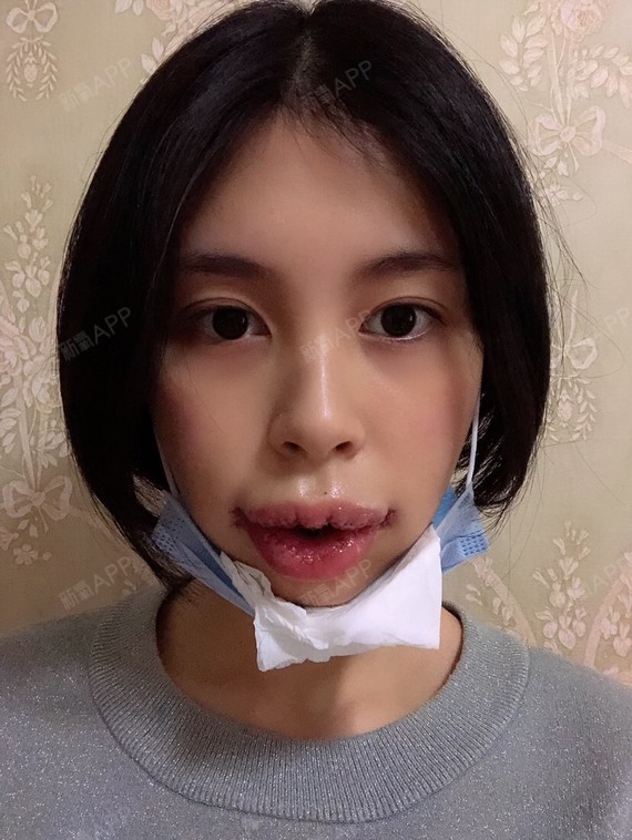 m唇手术
