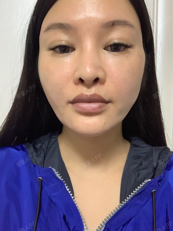 立马有效果,嘴角的下垂马上没了,真是神奇,期待后期慢慢变美