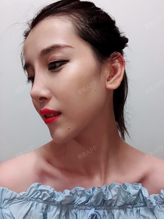 肋软骨隆鼻