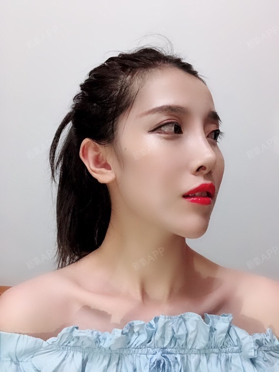 肋软骨隆鼻