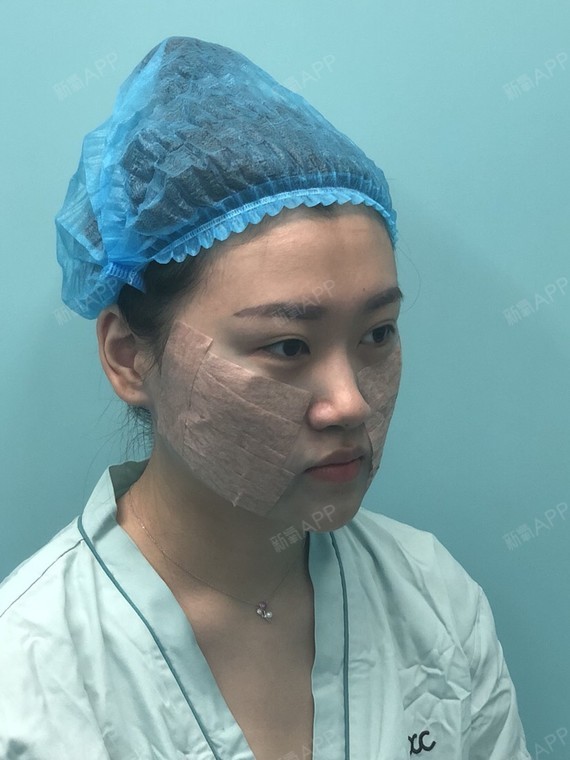 石棉棉棉埋线提升第3天美丽日记-新氧美容整形