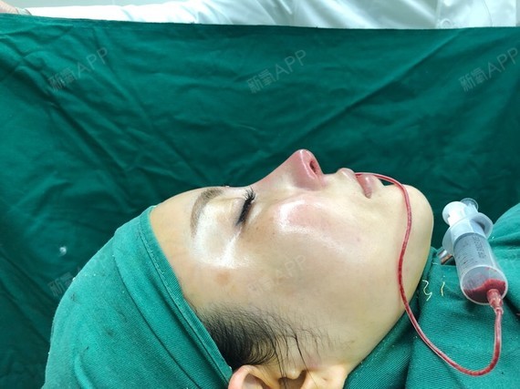 Pompidu鼻部修复第1天美丽日记-新氧美容整形