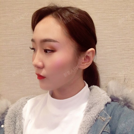 毒素yqj6l肉瘦脸丽日第7天美瘦脸记氧气针会发烧打了图片
