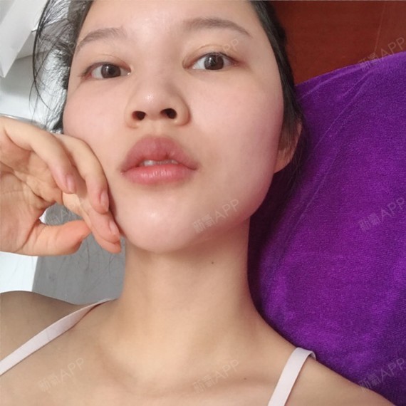 氧气yszzj硅胶隆鼻第7天美丽日记-新氧美容整形