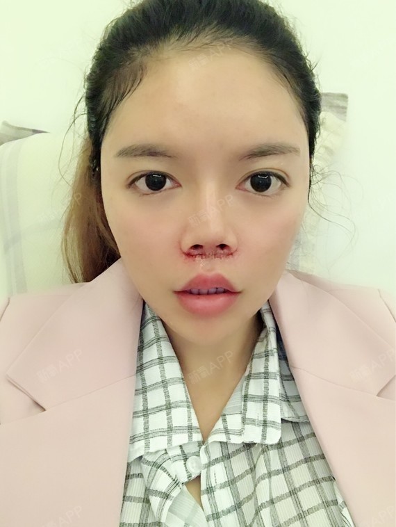 m唇手术