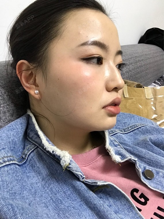 Rylynn面部吸脂第82天美丽日记-新氧美容整形