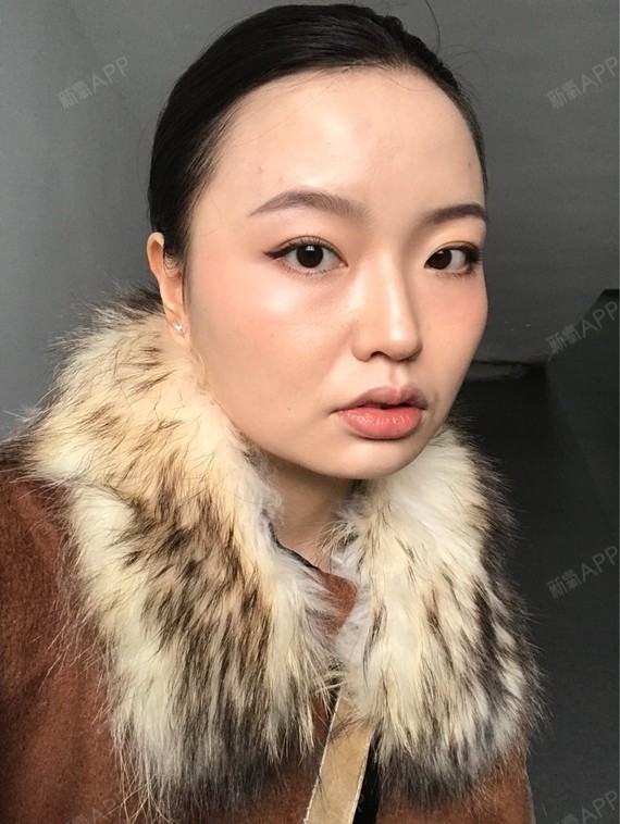 Rylynn面部吸脂第82天美丽日记-新氧美容整形