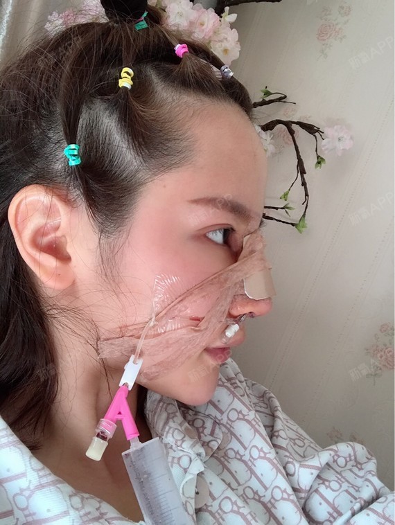 来自非洲的大美女膨体隆鼻第0天美丽日记