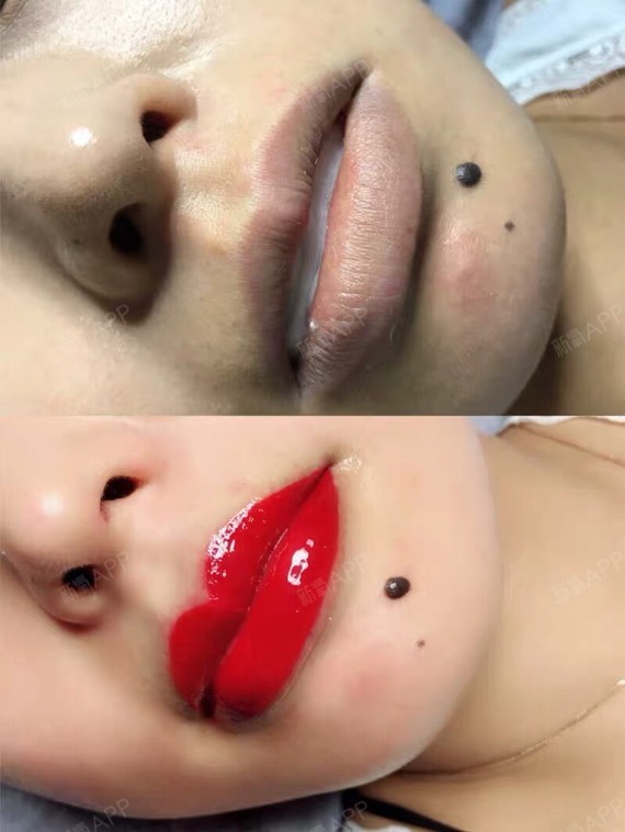 半永久纹唇