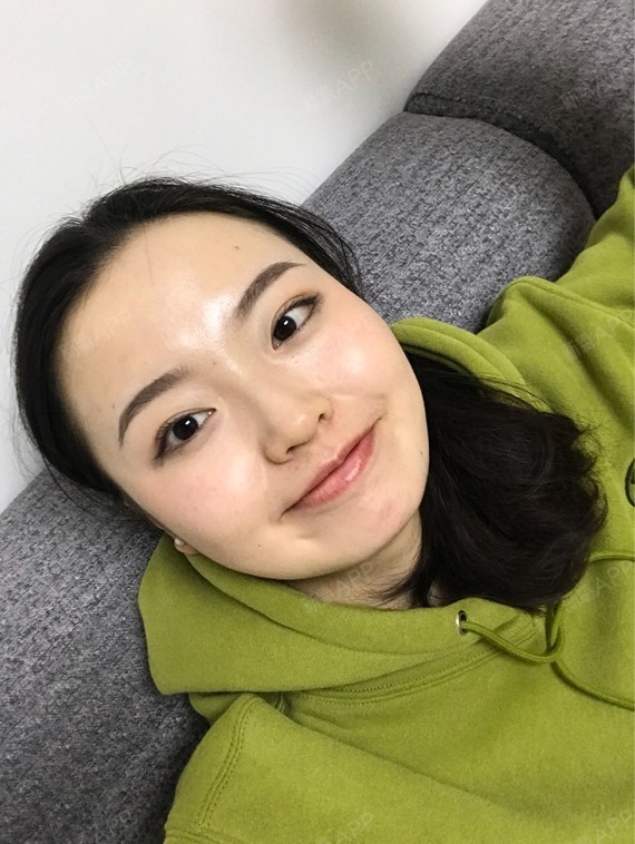 Rylynn面部吸脂第89天美丽日记-新氧美容整形