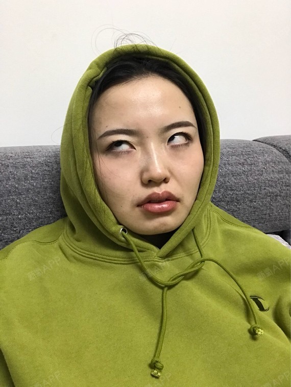 Rylynn面部吸脂第89天美丽日记-新氧美容整形