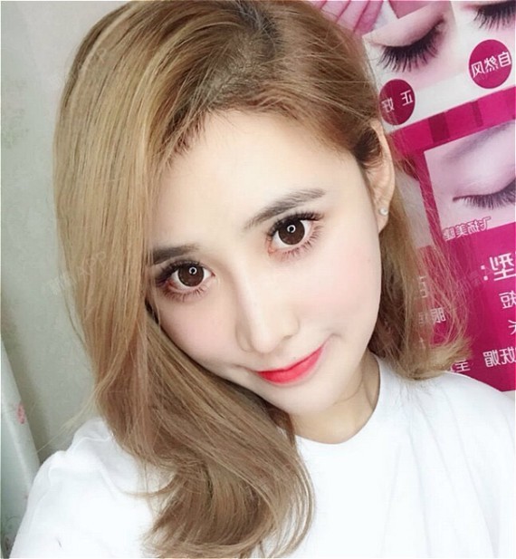 下巴截骨术好不好_效果图_小zz大酱紫下巴截骨术术后第657天_新氧美容
