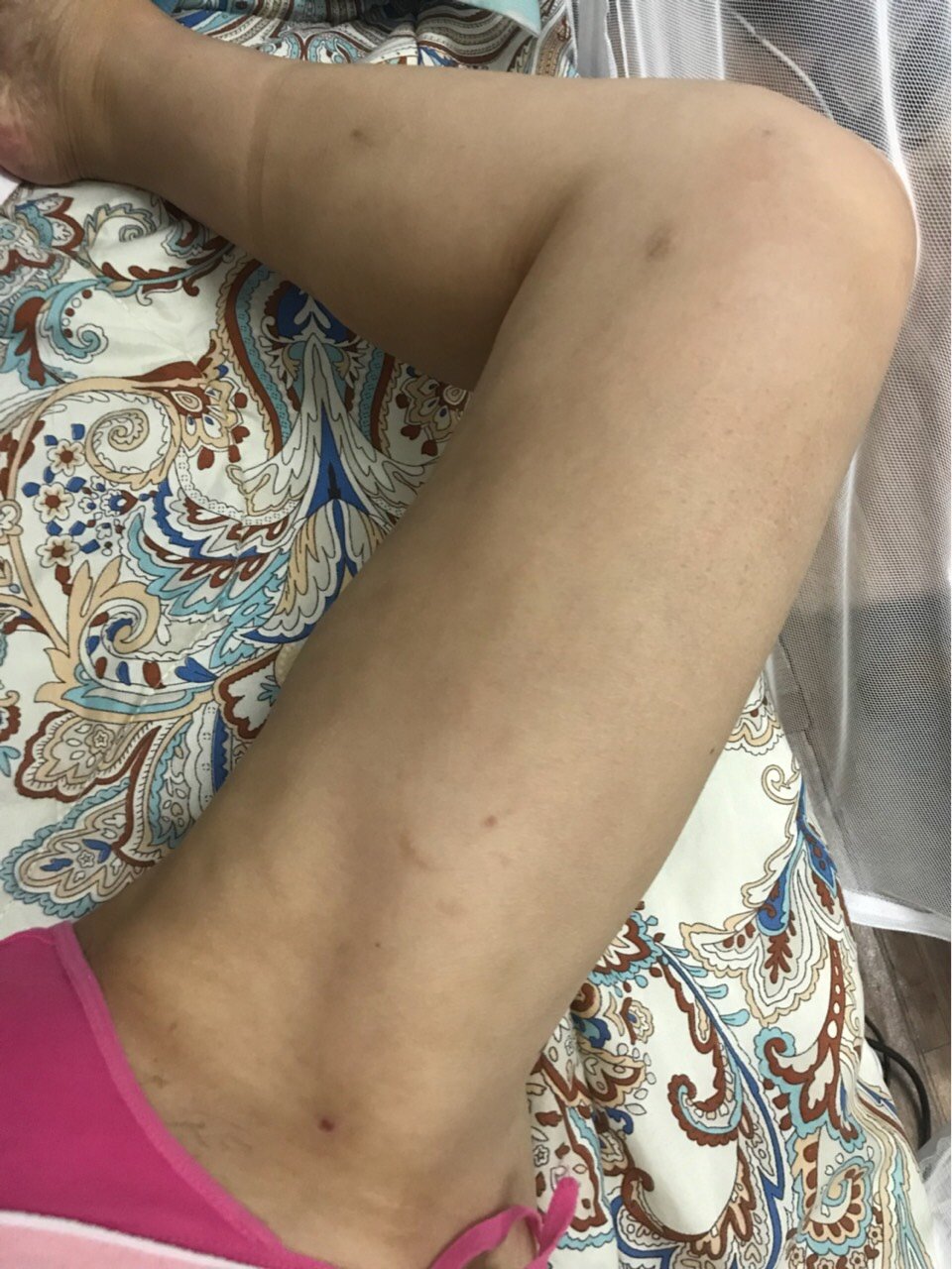 吸脂瘦大腿怎么样_恢复过程_效果如何_韩小坏整形日记