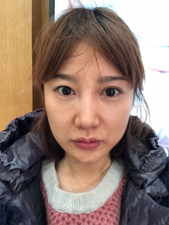 长草水光针很久了,一直害怕脸上留下针眼容易色素沉着