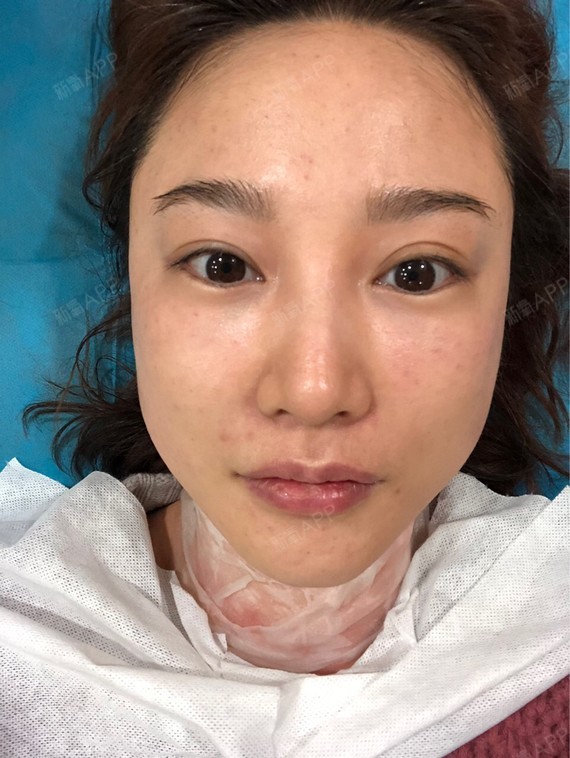 长草水光针很久了,一直害怕脸上留下针眼容易色素沉着