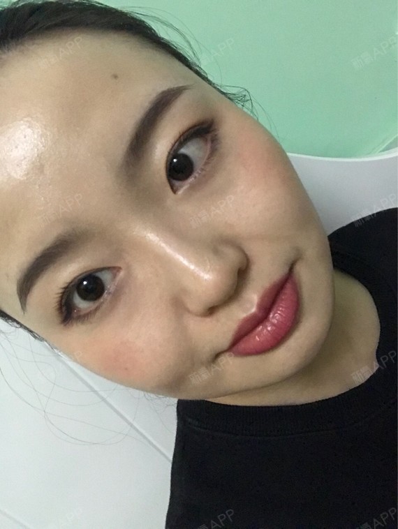 Rylynn面部吸脂第95天美丽日记-新氧美容整形