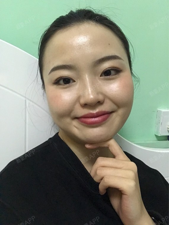 Rylynn面部吸脂第95天美丽日记-新氧美容整形