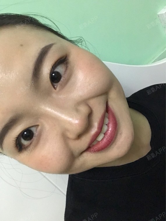 Rylynn面部吸脂第95天美丽日记-新氧美容整形