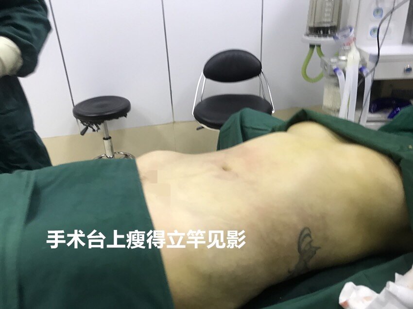 吸脂瘦腹部第0天