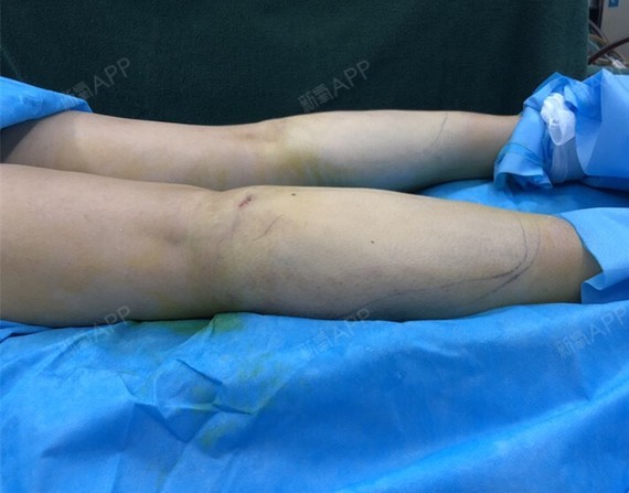 射频溶脂瘦小腿好不好_效果图_大美喵喵喵射频溶脂瘦2