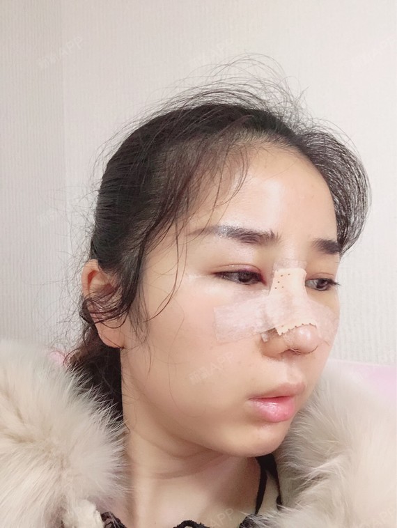 最肿应该就是现在,整个脸包括眼睛都肿了,晚上睡觉都几乎是坐着的